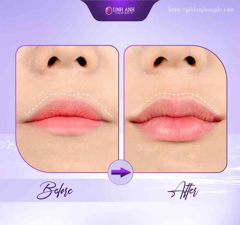 Tiêm Filler Giá Bao Nhiêu Tiền trên 1cc