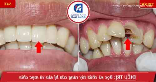 bọc sứ cho răng sau khi chữa tủy